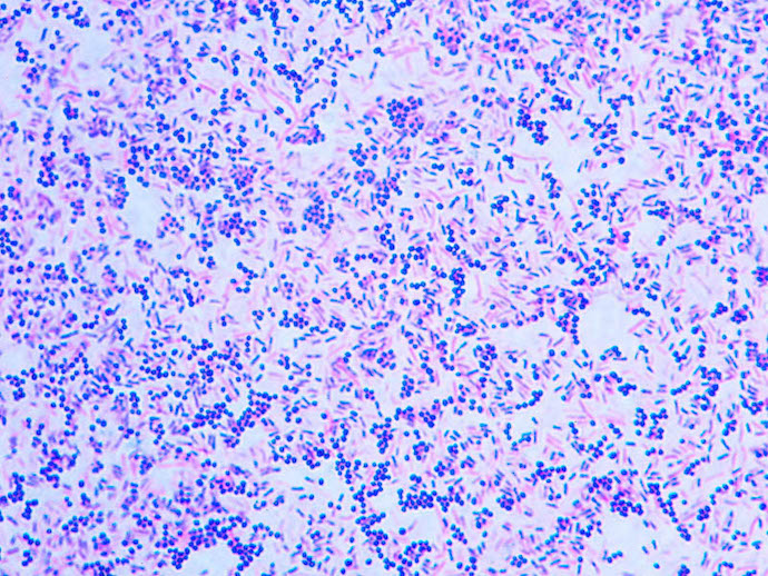 Gram stain with Gram positive cocci and Gram Negative bacilli 