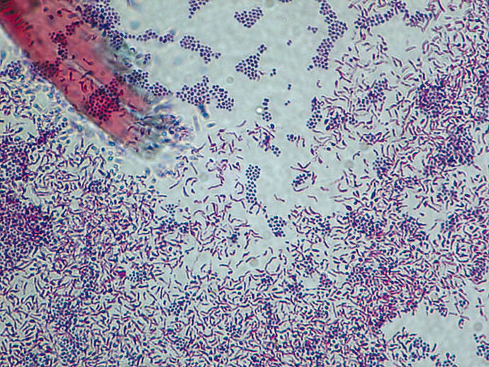 acid fast stain with red bacilli and blue cocci
