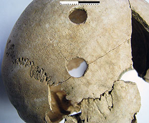 close up of cracked skull