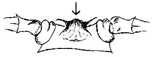 Prosternum with median tubercle.