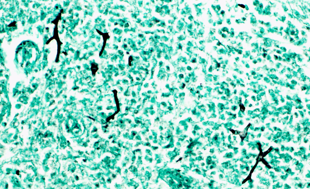 fungal hyphae in a gms stain